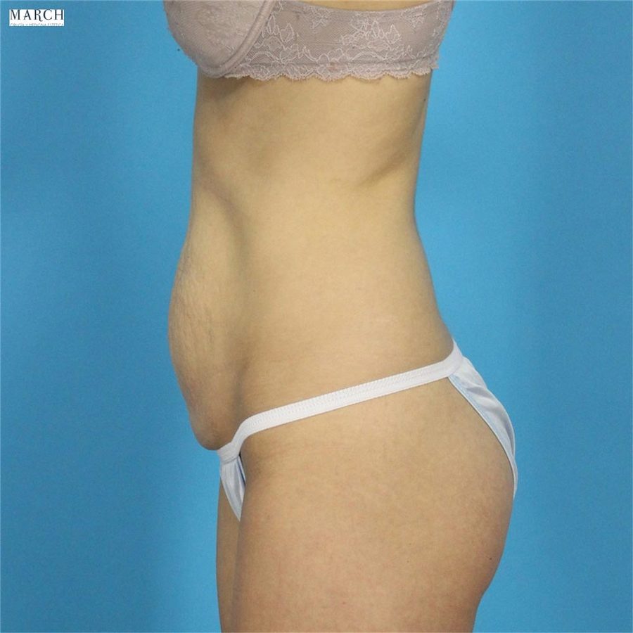 Abdominoplastia: antes (vista lateral)