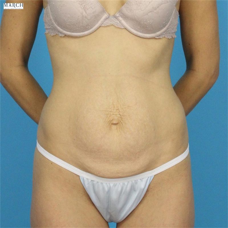 Abdominoplastia: antes