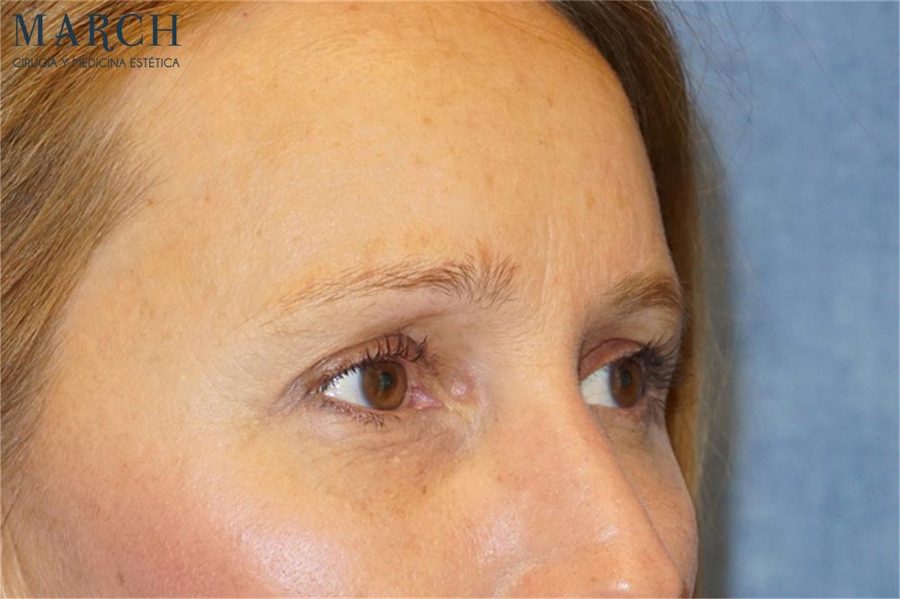 Blefaroplastia: antes (vista oblicua)