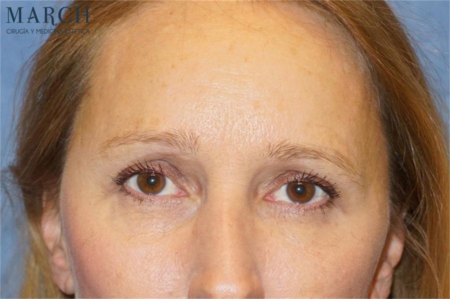 Blefaroplastia: antes