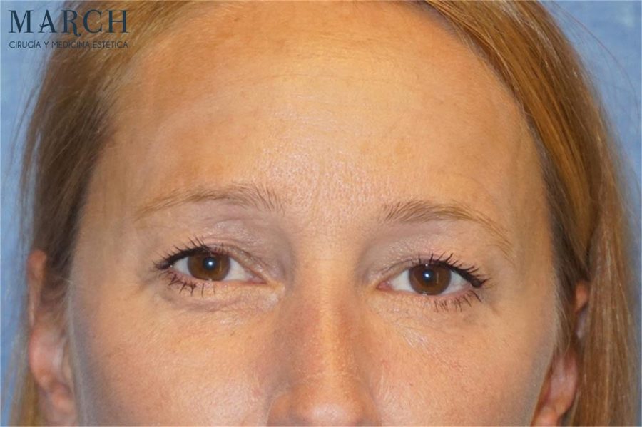Blefaroplastia: después (vista frontal)