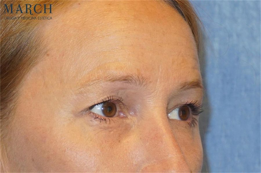 Blefaroplastia: después (vista oblicua)