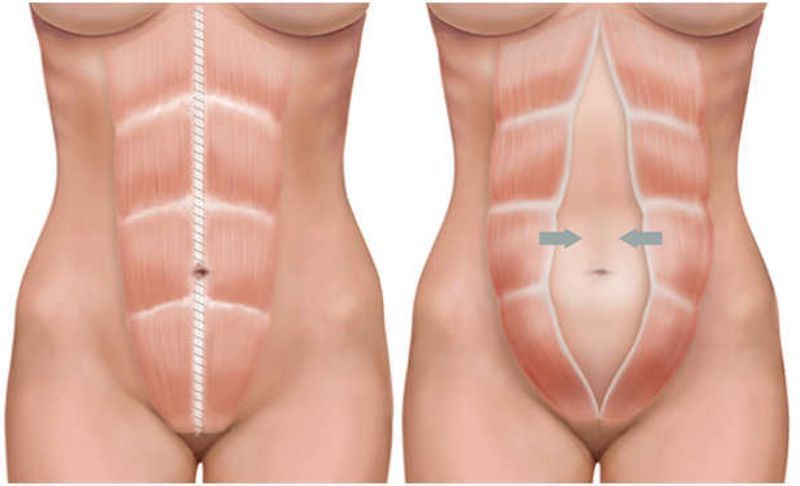 Ilustración: abdominoplastia y liposucción