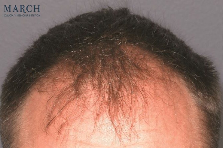 Injerto capilar: antes (línea frontal)