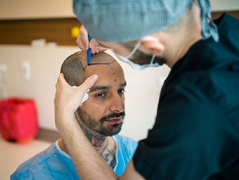 Injerto capilar y medicina estética corporal en Marbella