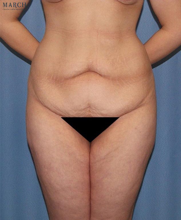 Liposucción y lipoescultura: antes (vista frontal)