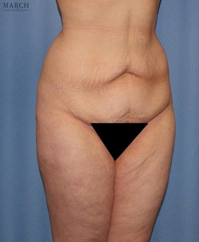 Liposucción y lipoescultura: antes (vista oblicua)