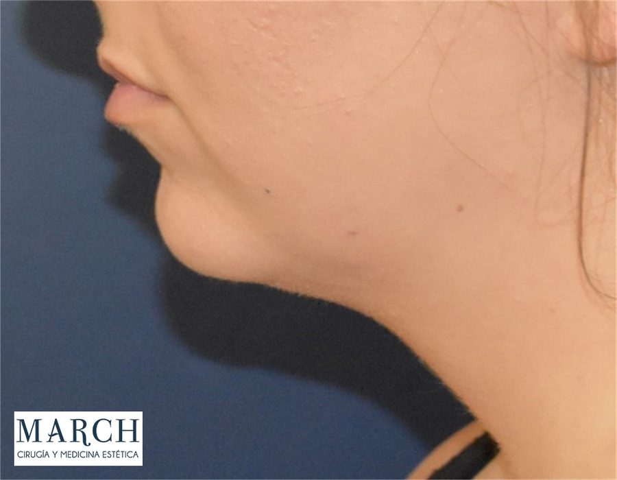 Mentoplastia: antes (perfil)