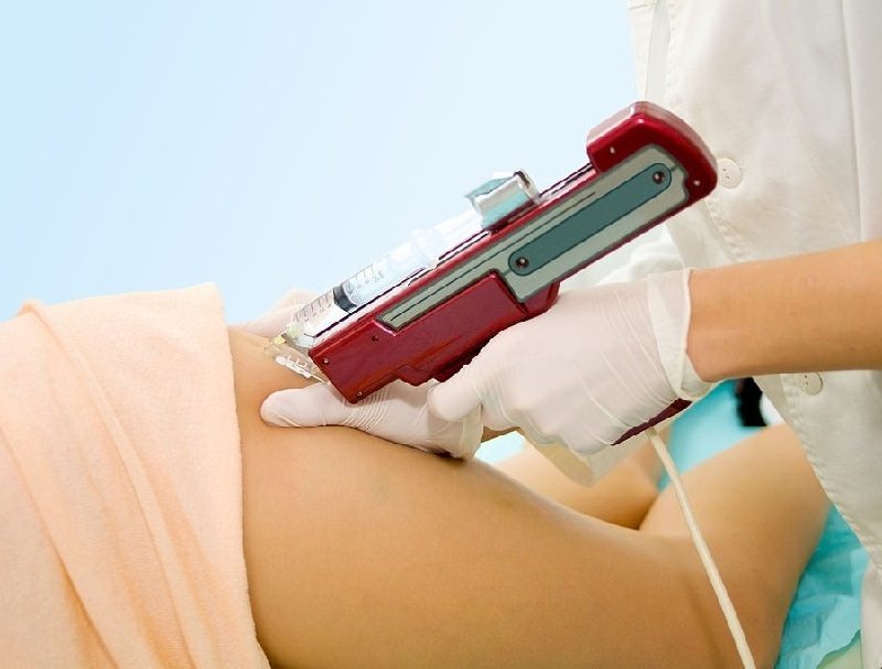 Mesoterapia corporal en Marbella