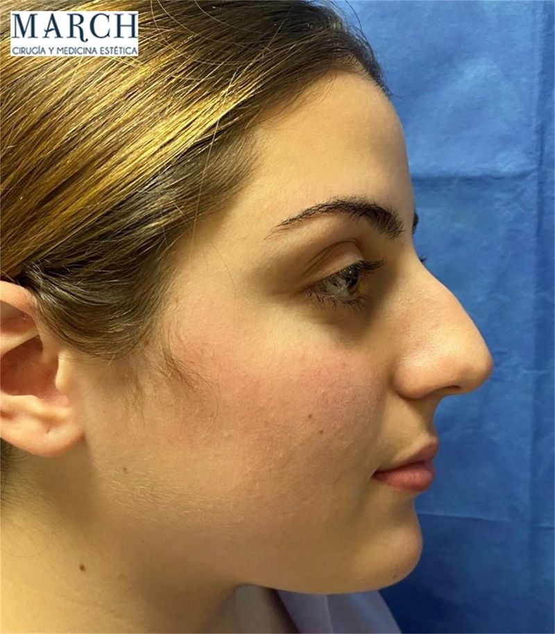 Rinoplastia: antes