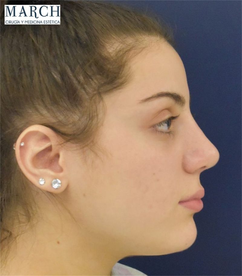 Rinoplastia: después