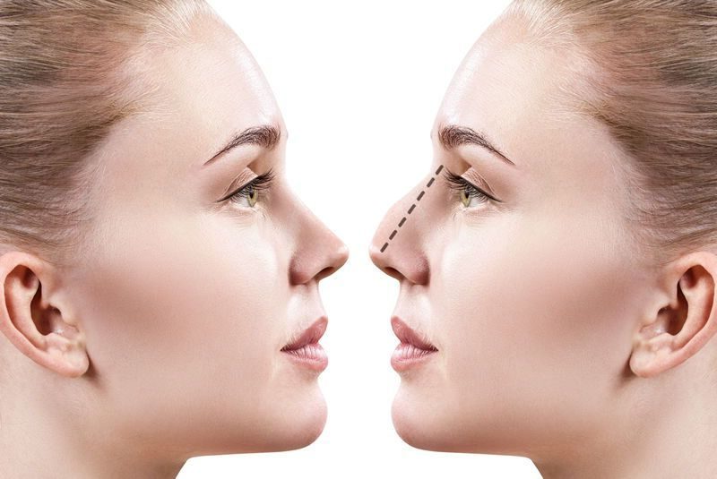 Rinoplastia en Marbella